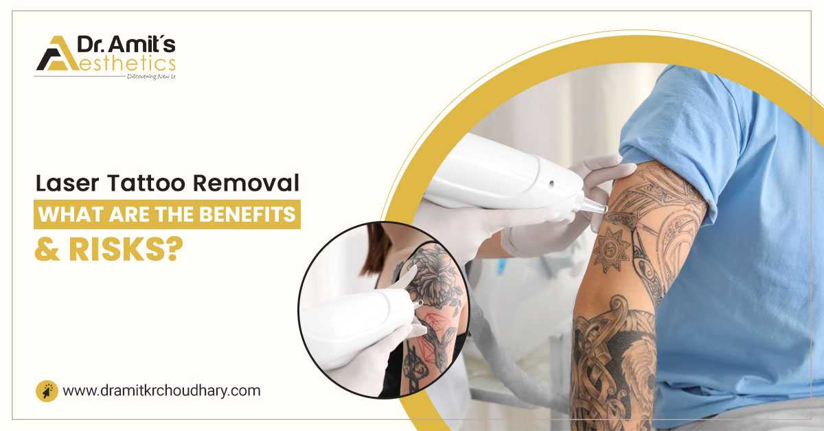 Laser Tattoo Removal: What Are the Benefits and Risks