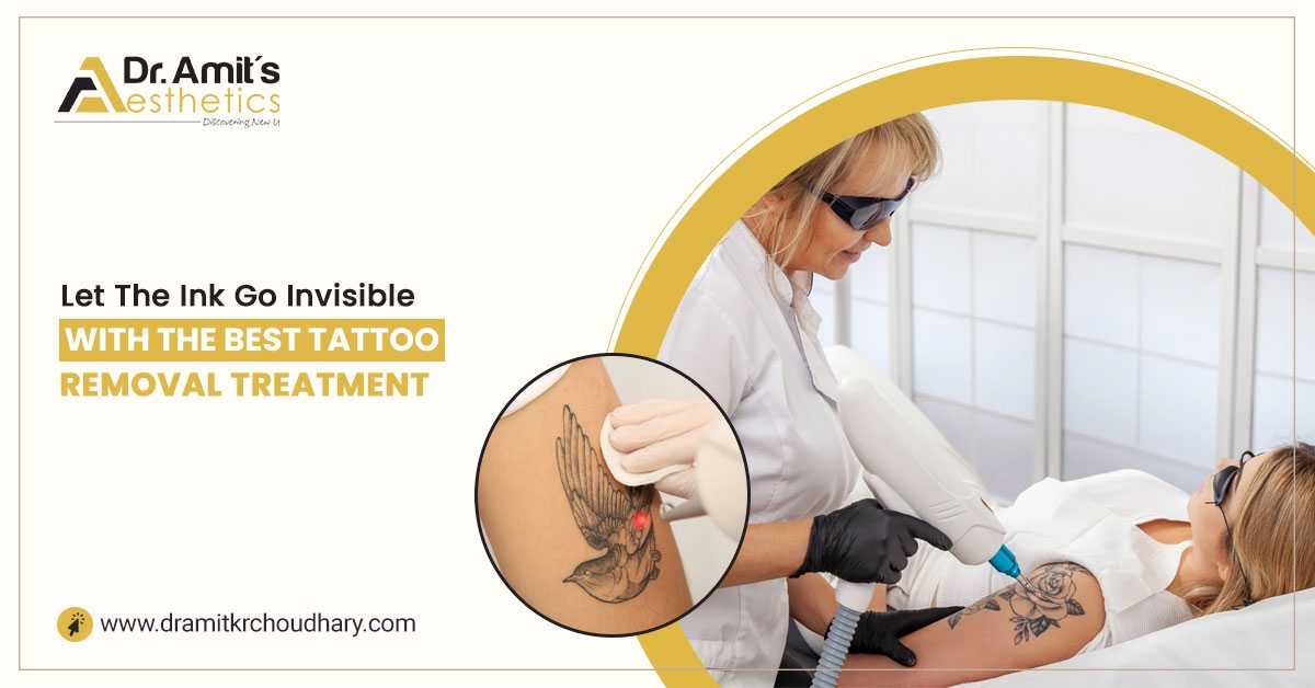 Let the Ink Go Invisible with the Best Tattoo Removal Treatment