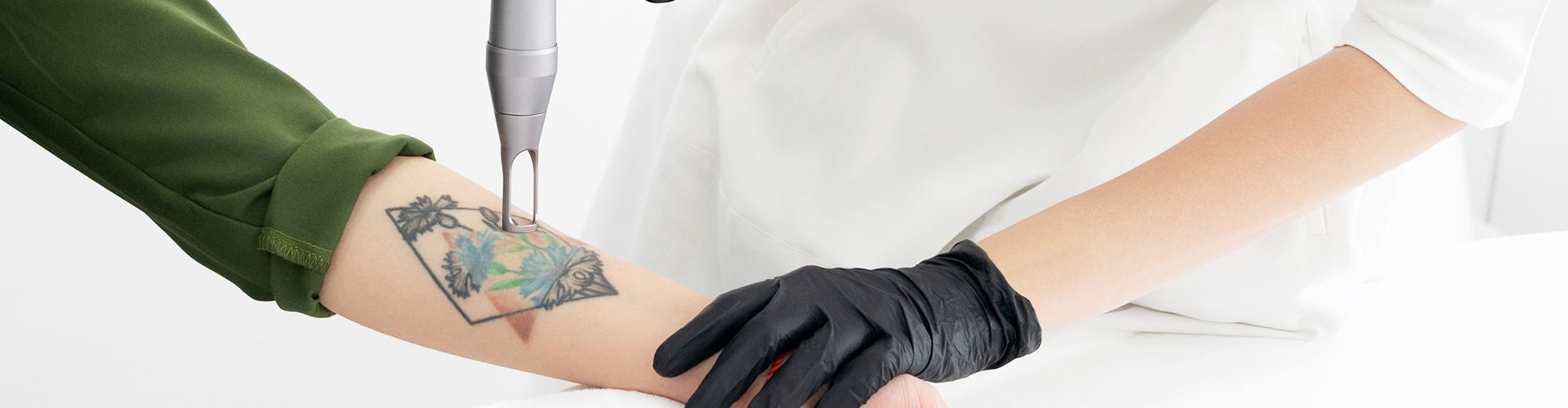 Tattoo Removal In Siliguri