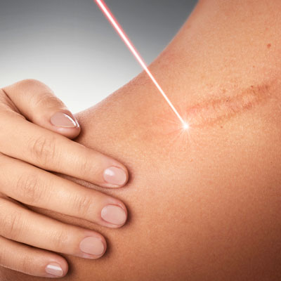 Laser Scar Treatment In Siliguri